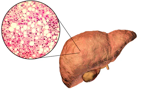 GOUT : Punca & Tips Merendahkan Urik Asid